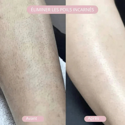 NuitLisse™ Épilation sans douleur pour une peau parfaitement lisse