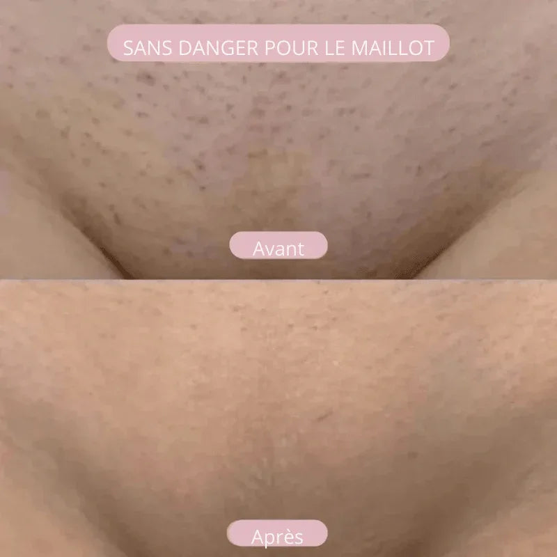 NuitLisse™ Épilation sans douleur pour une peau parfaitement lisse